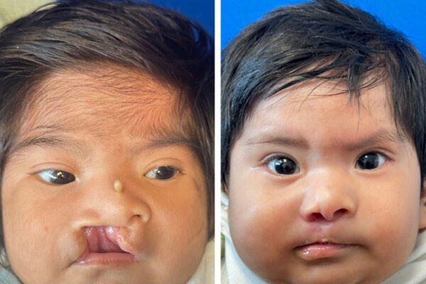 lip-reconstruction-2-1