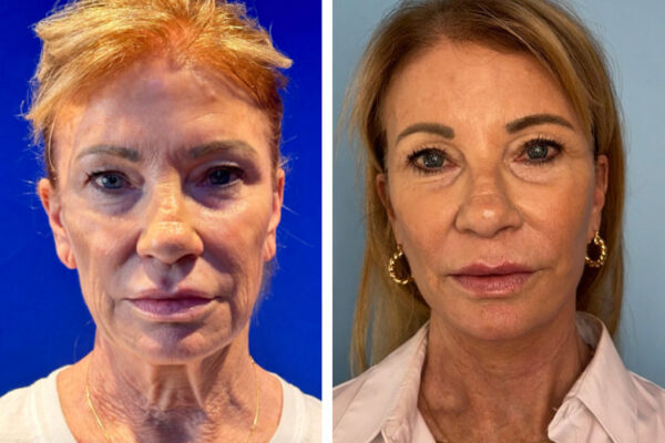 facelift-neck-lift-1a facelift-neck-lift-1a