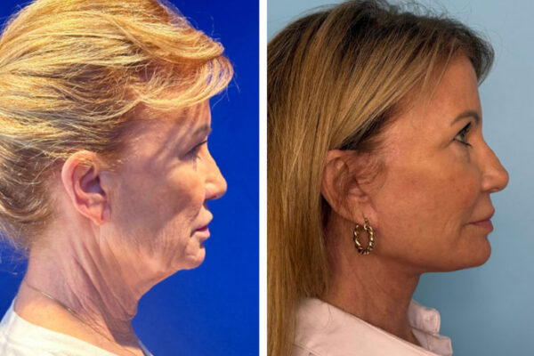 facelift-neck-lift-1b facelift-neck-lift-1b