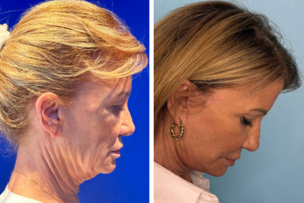 facelift-neck-lift-1c facelift-neck-lift-1c