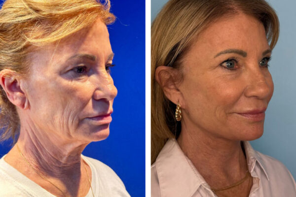 facelift-neck-lift-1d facelift-neck-lift-1d