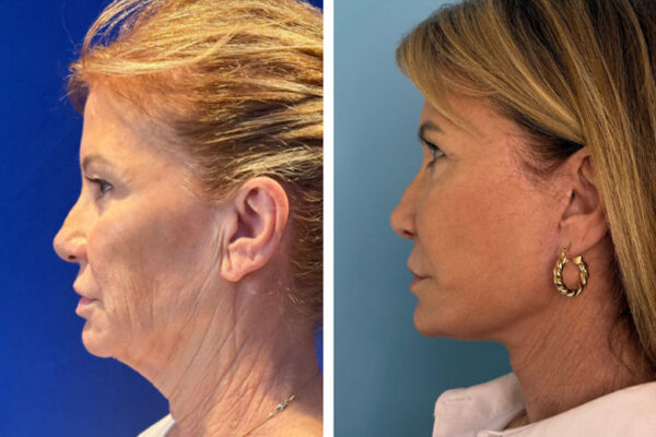 facelift-neck-lift-1e facelift-neck-lift-1e