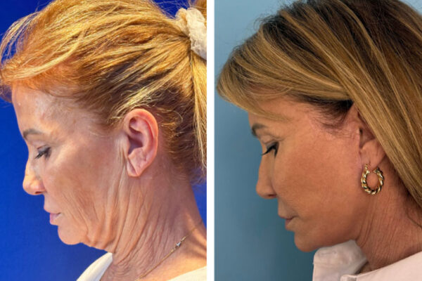 facelift-neck-lift-1f facelift-neck-lift-1f