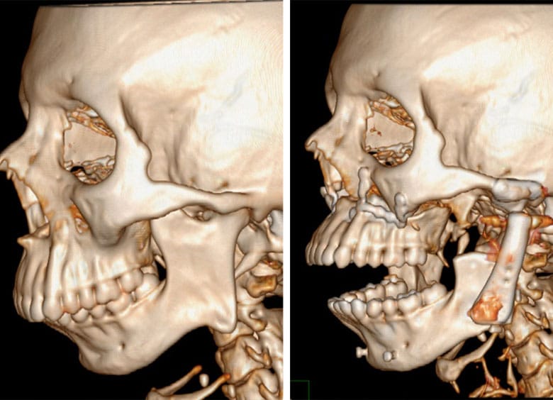 upper-lower-jaw-3c
