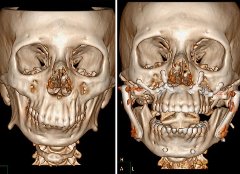 upper-lower-jaw-3d